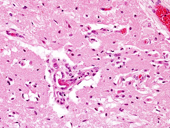 9B5C Infarct, Embolic (Hrt fibrin plt emboli) Case 9