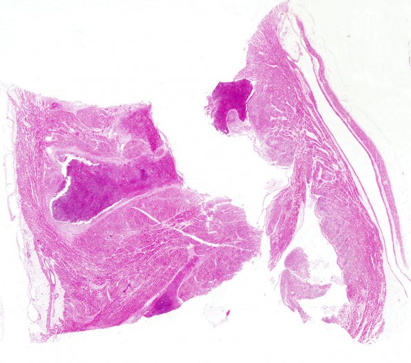 9C1 Infarct, Embolic (Hrt fibrin plt emboli) Case 9 5