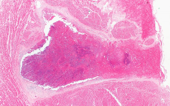 9C2 Infarct, Embolic (Hrt fibrin plt emboli) Case 9 Heart 2X