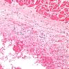 9C3 Infarct, Embolic (Hrt fibrin plt emboli) Case 9 4