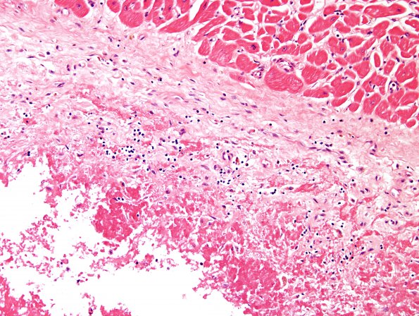 9C3 Infarct, Embolic (Hrt fibrin plt emboli) Case 9 4