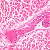 9C4 Infarct, Embolic thrombi) (Case 9) Heart 20X