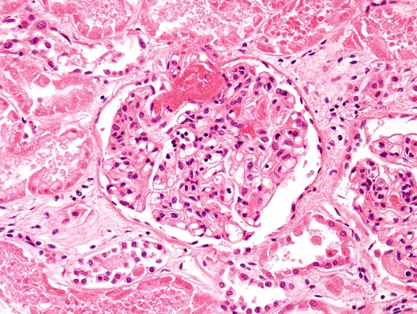 9D Infarct, Embolic (Hrt fibrin plt emboli) Case 9 kidney