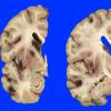 10A1 Infarct, hemorrhagic, 6 days (Case 10) 2