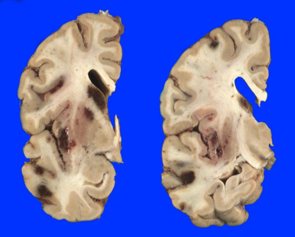 10A1 Infarct, hemorrhagic, 6 days (Case 10) 2