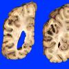 10A1 Infarct, hemorrhagic, 6 days (Case 10) 4