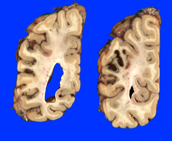 10A1 Infarct, hemorrhagic, 6 days (Case 10) 4