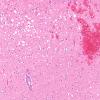 10B2 Infarct, hemorrhagic, 6 days (Case 10) L3 H&E 10X