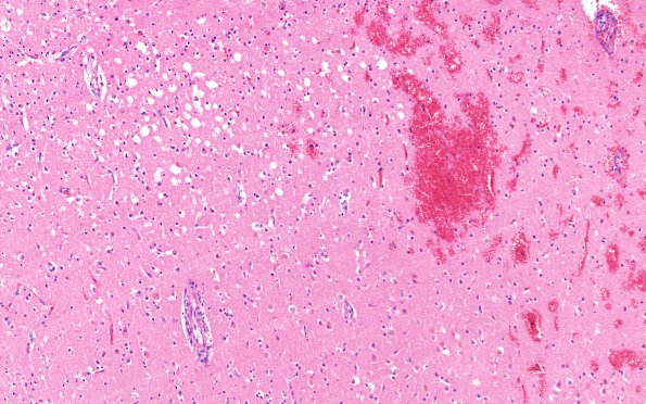 10B2 Infarct, hemorrhagic, 6 days (Case 10) L3 H&E 10X