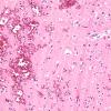 10B3 Infarct, hemorrhagic, 6 days (Case 10) L3 H&E 20X