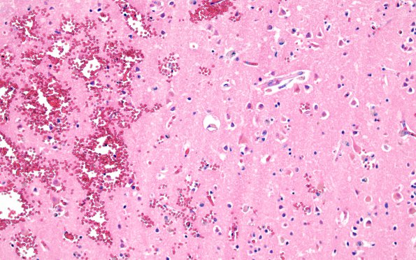 10B3 Infarct, hemorrhagic, 6 days (Case 10) L3 H&E 20X