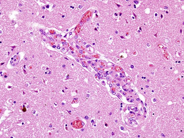 10B4 Infarct, hemorrhagic, 6 days (Case 10) H&E 1