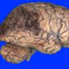 11A1 Infarct, Hemorrhagic (Case 11) 4