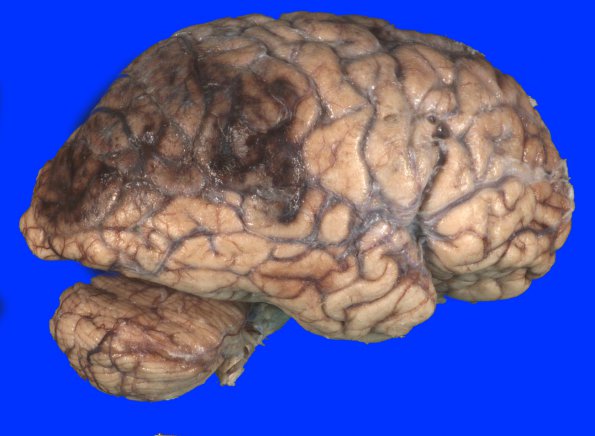 11A1 Infarct, Hemorrhagic (Case 11) 4