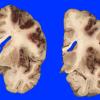 11A2 Infarct, Hemorrhagic (Case 11) 9