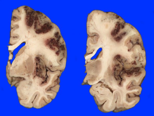 11A2 Infarct, Hemorrhagic (Case 11) 9