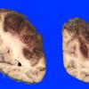 11A3 Infarct, Hemorrhagic (Case 11) 11