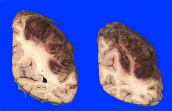 11A3 Infarct, Hemorrhagic (Case 11) 11