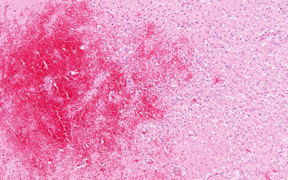 11B2 Infarct, Hemorrhagic (Case 11) H&E L2b 10X