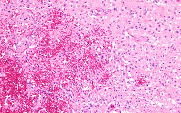 11B3 Infarct, Hemorrhagic (Case 11) H&E L2b 20X