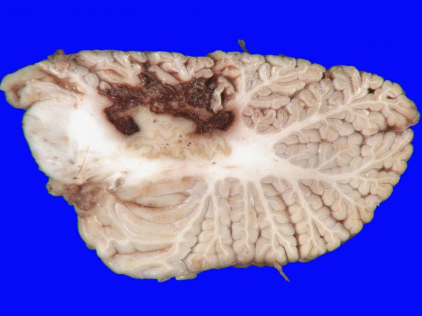 12A1 Infarct, hemorrhagic (Case 12) 1