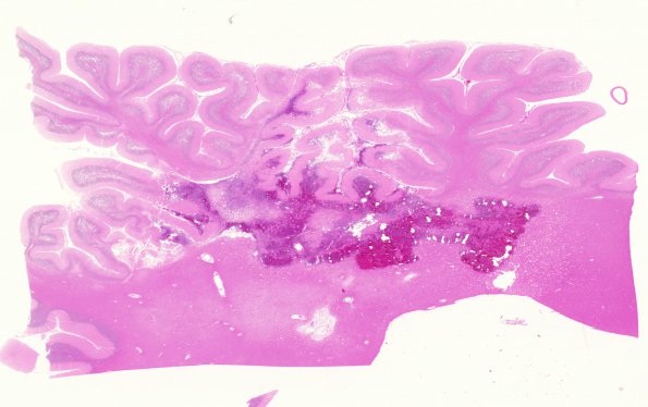 12B1 Infarct, hemorrhagic (Case 12) N16 H&E WM