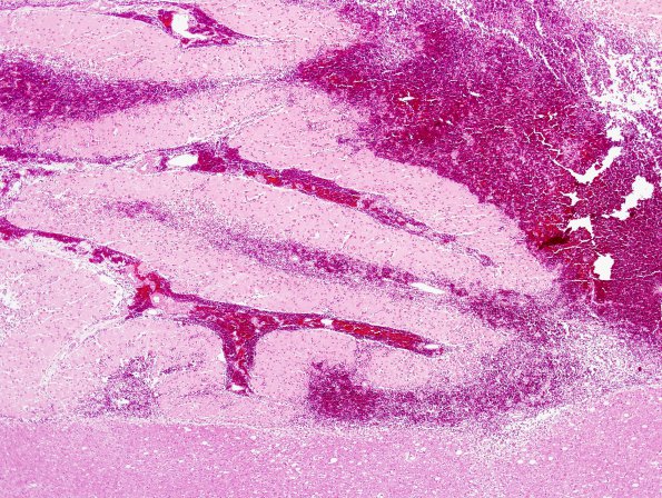 12B2 Infarct, hemorrhagic (Case 12) H&E 1