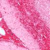 12B3 Infarct, hemorrhagic (Case 12) N16 H&E 10X 2