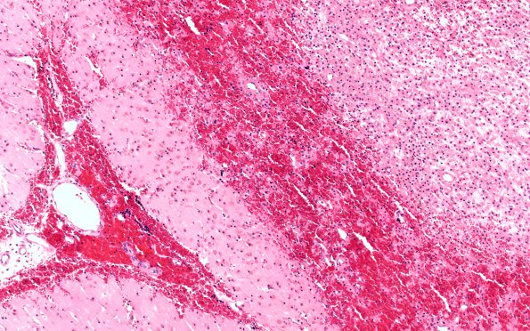 12B3 Infarct, hemorrhagic (Case 12) N16 H&E 10X 2