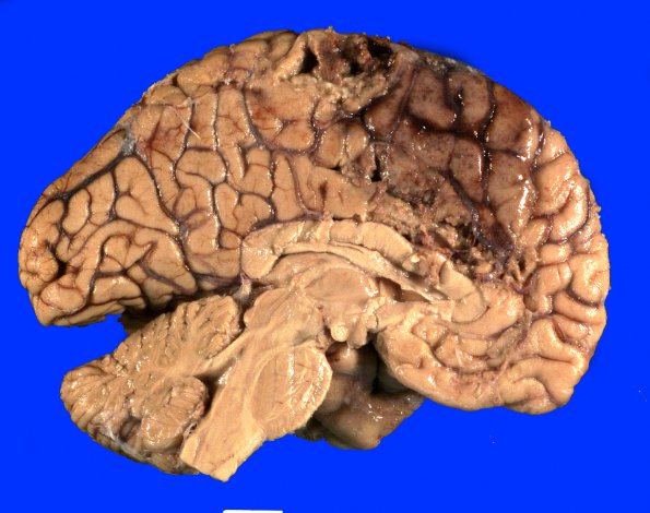 13A1 Infarct, hemorrhagic (Case 13) _4