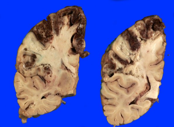 13A2 Infarct, hemorrhagic (Case 13) 6