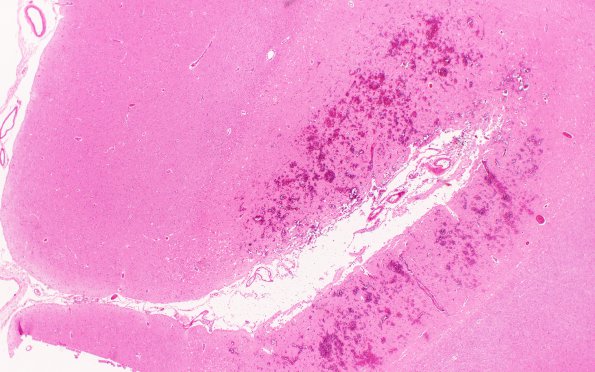 13B2 Infarct, hemorrhagic (Case 13) L1 WM 2