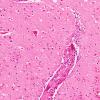 13B3 Infarct, hemorrhagic (Case 13) L1 H&E 20X