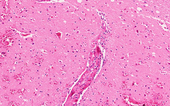 13B3 Infarct, hemorrhagic (Case 13) L1 H&E 20X