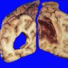 14A1 Infarct, hemorrhagic (Case 14) 1