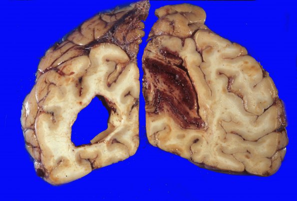 14A1 Infarct, hemorrhagic (Case 14) 1