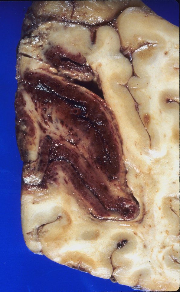 14A2 Infarct, acute, hemorrhaic (Case 14)