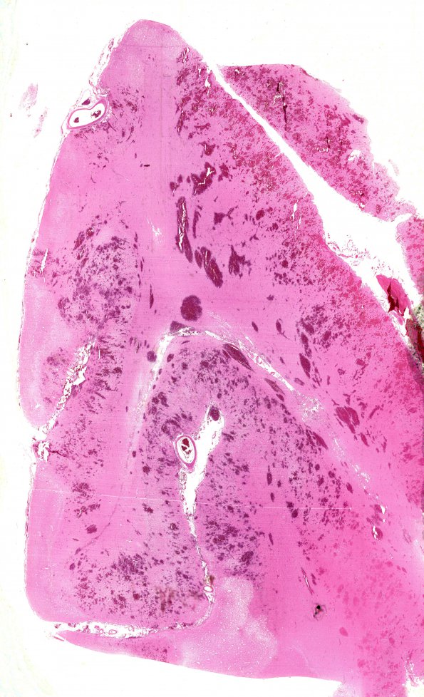 14B Infarct, acute, hemorrhaic (Case 14) R post pole