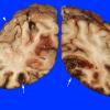 15A1 Infarct, hemorrhagic (Case 15) gross 1A copy