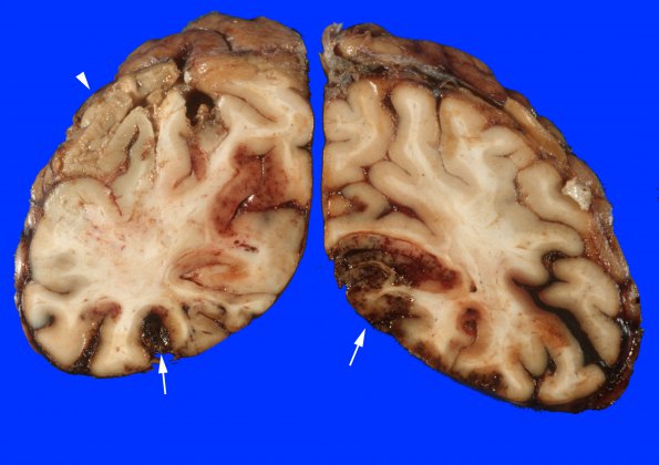 15A1 Infarct, hemorrhagic (Case 15) gross 1A copy