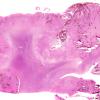 15B Infarct, hemorrhagic (Case 15) F WM