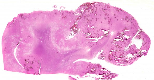 15B Infarct, hemorrhagic (Case 15) F WM