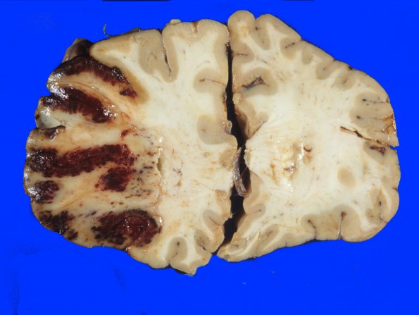 16A1 Infarct, hemorrhagic (Case 16) gross A