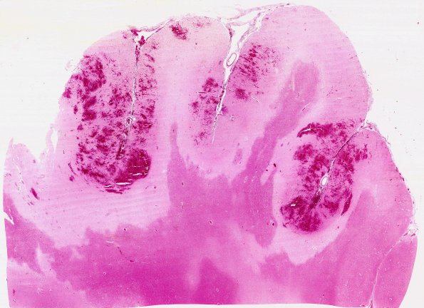 16B1 Infarct, hemorrhagic (Case 16) G H&E WM