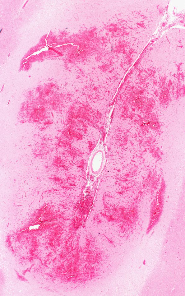 16B2 Infarct, hemorrhagic (Case 16) G H&E 2X 1