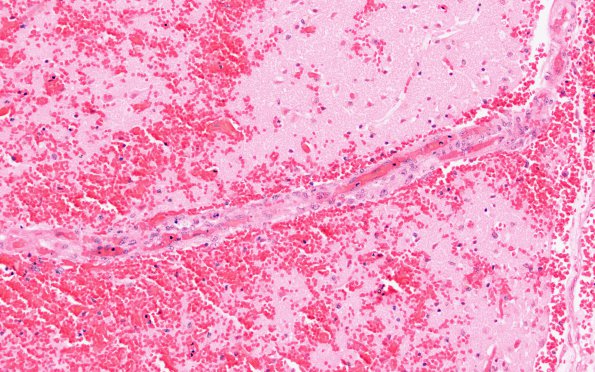 16B3 Infarct, hemorrhagic (Case 16) G H&E 20X 1