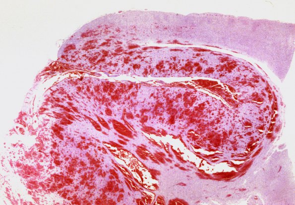 17A2 Infarct, Hemorrhagic 13b