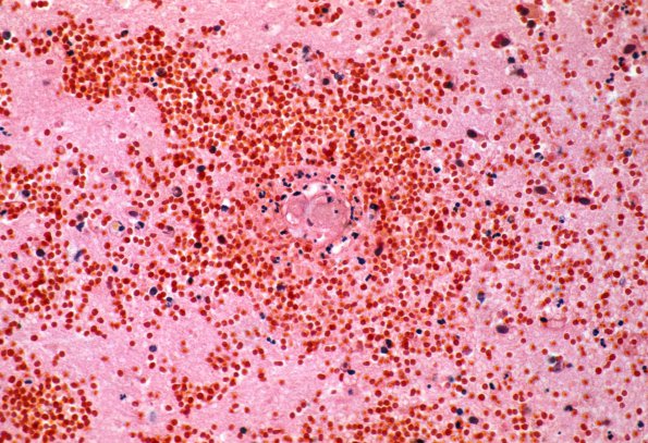 17A3 Infarct, Hemorrhagic 63