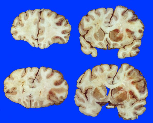 18 Infarct, hemorrhagic