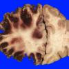 1A1 Infarct, recent, hemorrhagic (Case 1) 4